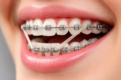 Bagues et élastiques orthodontiques en bouche